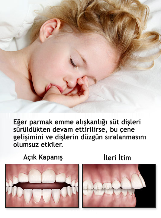 Parmak Emme Faydali Bilgiler Ortodontist Doktor V Selcuk Cin